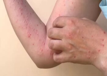 OMS rebautiza la viruela del mono como “mpox” para evitar estigmatización