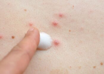 OMS cambia el nombre de viruela del mono a mpox